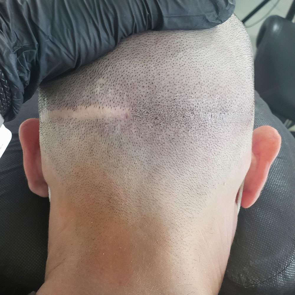 scalp scar cover in honolulu